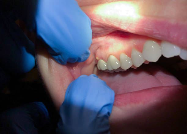 Best Emergency Denture Repair in Warren Park, IN